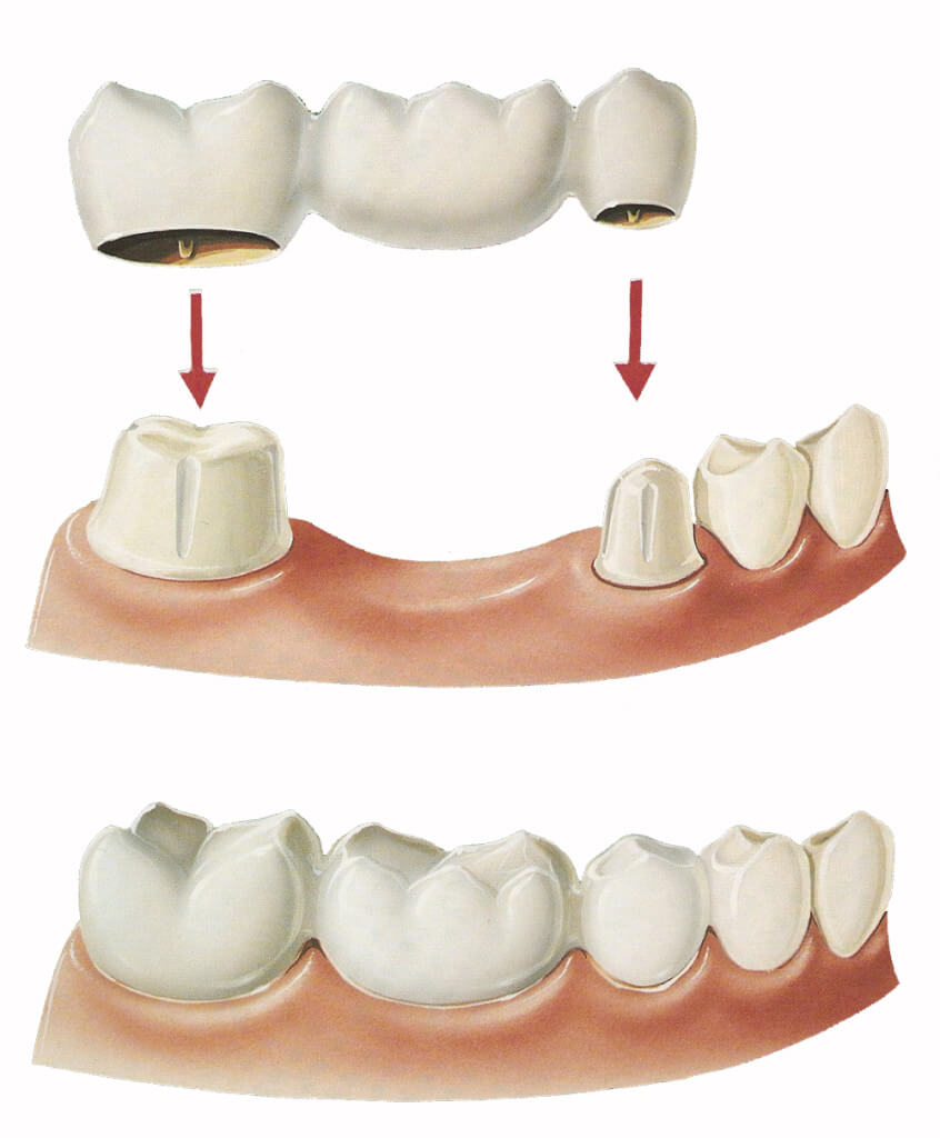 Crowns-and-Bridges-Dentist