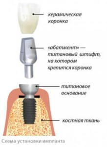 Импланты 300 мл фото